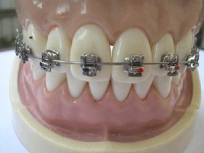 Sure-Series-Orthodontic-Self-Ligating-Bracket.jpg