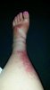 disney rash early week.jpg