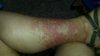 disney rash 2 weeks after home.jpg