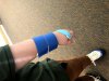broken wrist.jpg