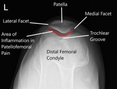 Runners-Knee2-480x366.jpg