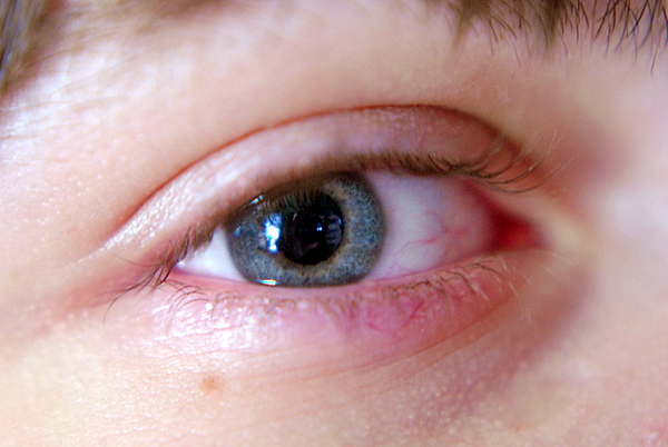 Ben's eye