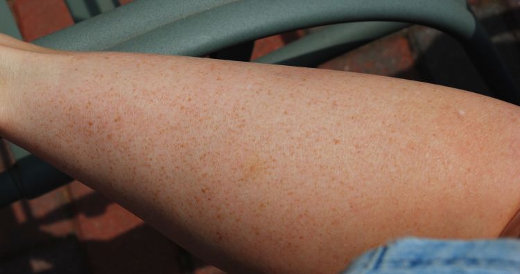 Freckles