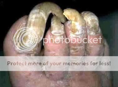 toenail-fungus-worst.jpg